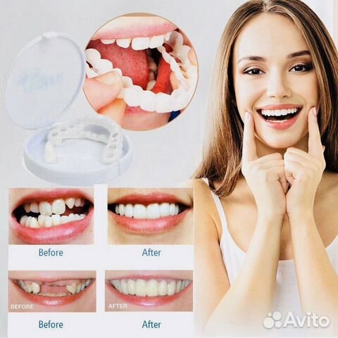 Виниры Snap-On Smile Виниры Snap-On Smile
