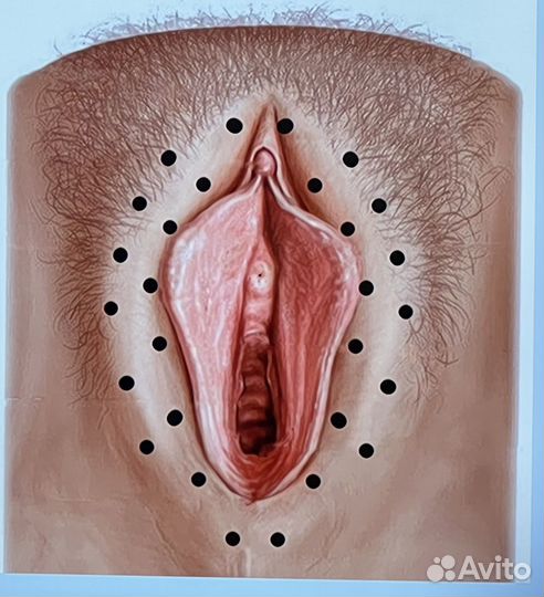 Интимное омоложение