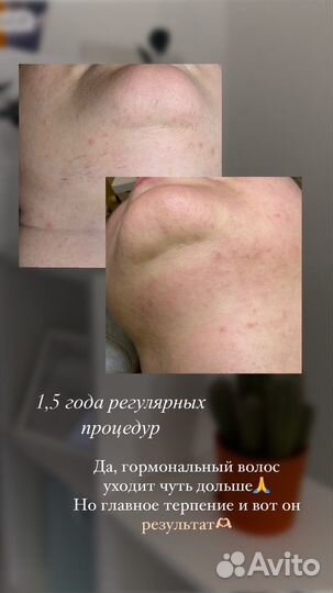 Модели на электроэпиляцию