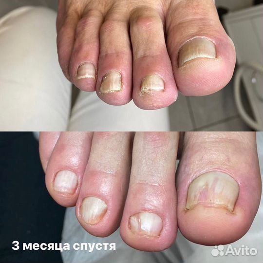 Педикюр подолог
