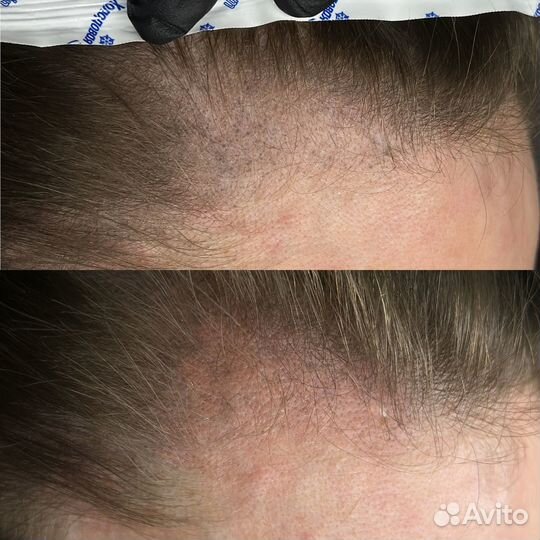 Выведение тату