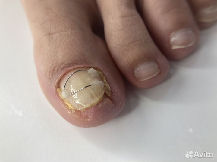 Модель на титановую нить (педикюр)