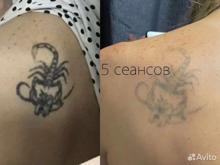 Удаление тату