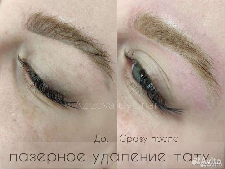 Удаление тату/перманента/татуировок/татуажа бровей