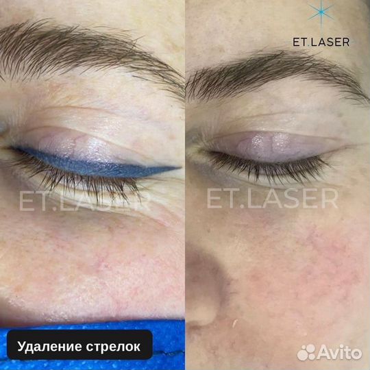 Удалить татуаж