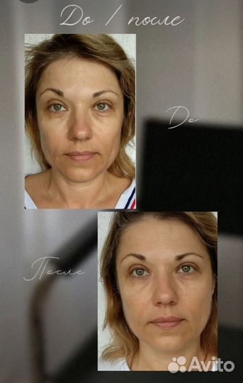 Аппаратный вакуумный массаж вибро баночный массаж