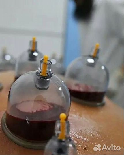 Лазерная эпиляция: бакенбарды