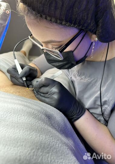 Электроэпиляция