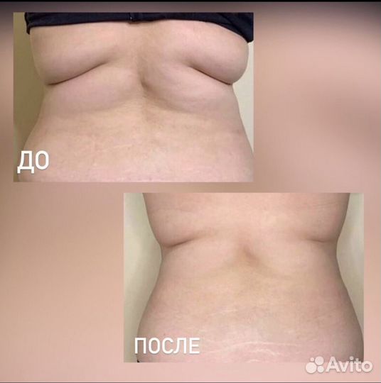 Увеличение губ