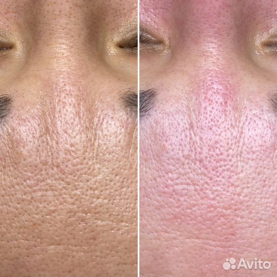 Чистка лица