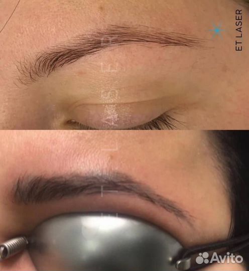 Удалить татуаж