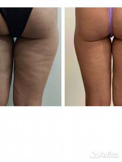 Аппаратный массаж, жиротоп