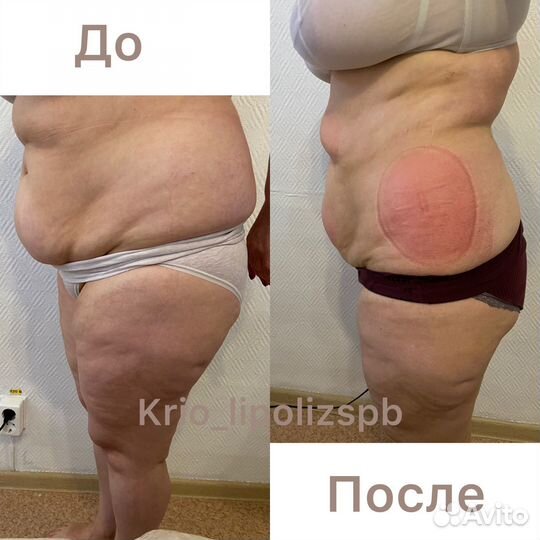 Криолиполиз услуги