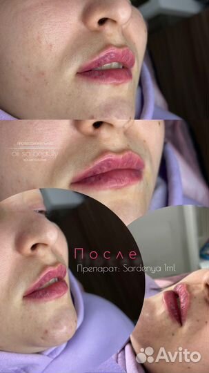 Увеличение губ, увлажнение 0,5мл; 1мл