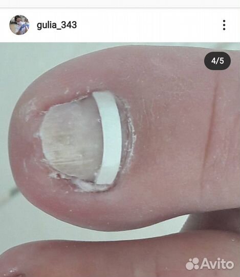 Медицинский педикюр вросший ноготь