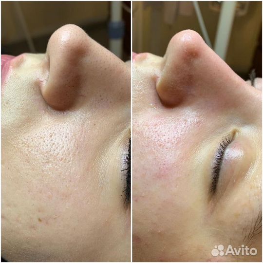 Комбинированная чистка