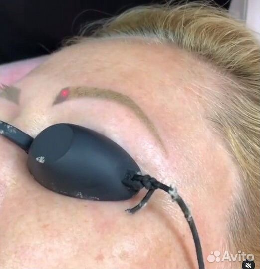 Удаление тату и перманентного макияжа