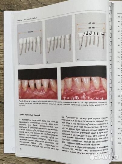 Керамические виниры