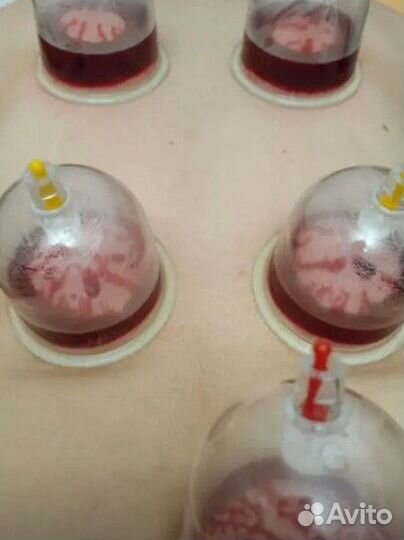 Обучение хиджамы