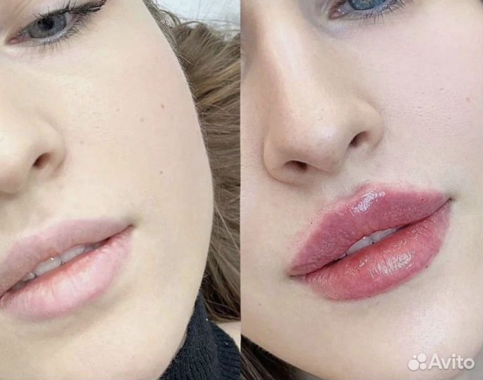 Увеличение губ