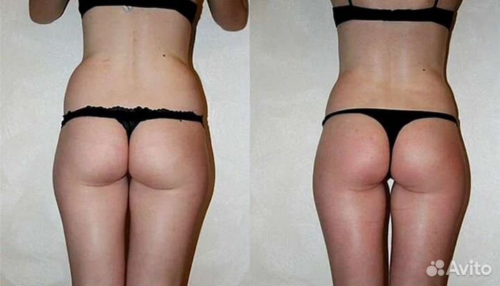 Emsculpt процедура (прокачка мышц )