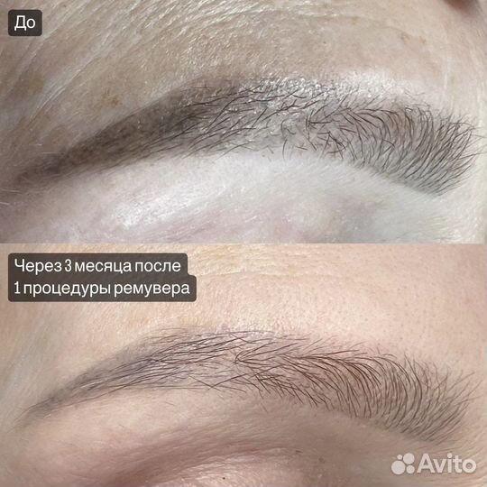 Удаление татуажа/тату ремувером/лазером, Перманент