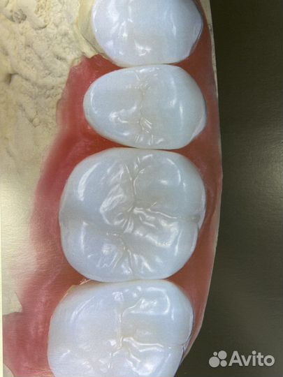 Протезирование