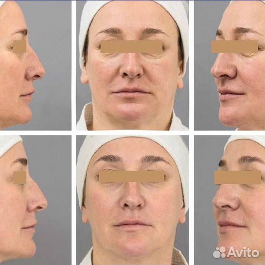 СМАС лифтинг, тотальное омоложение лица