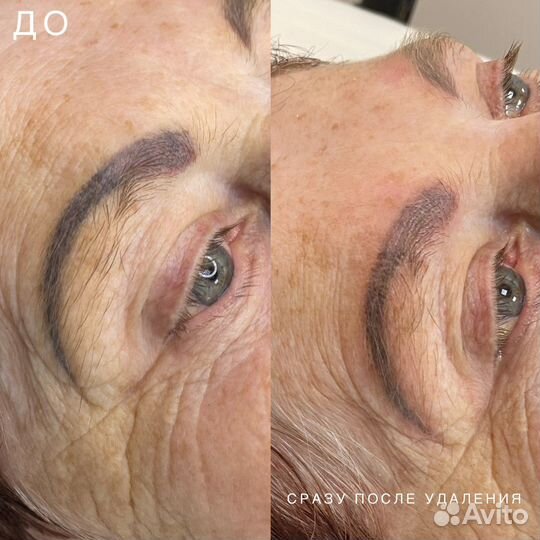 Лазерное удаление татуажа и тату