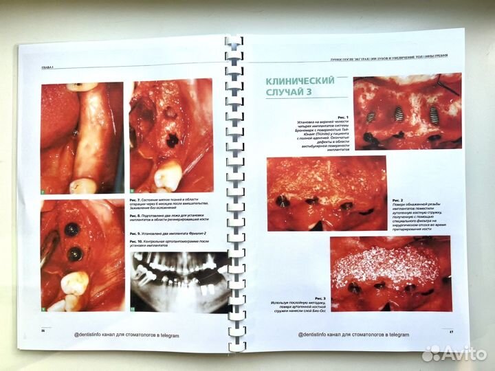 Передовые методики регенерации кости