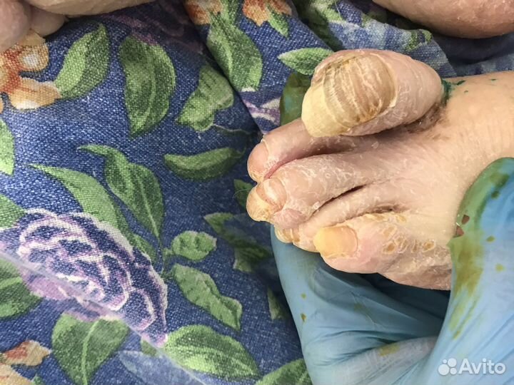 Медицинский Педикюр на дому для пожилых