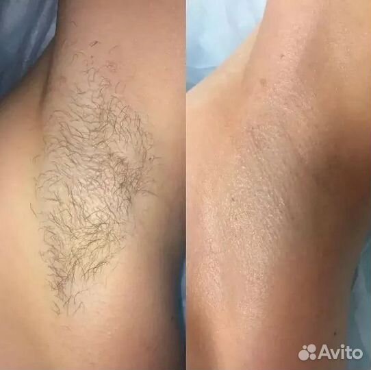Шугаринг/Сахарная депиляция