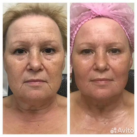 Скульптурно-буккальный массаж