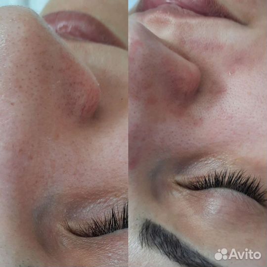 Косметология, контурная пластика