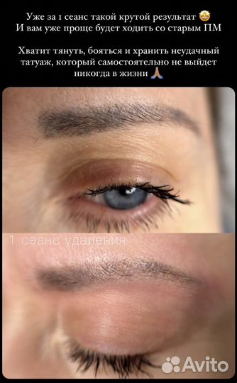 Лазерное удаление тату и татуажа