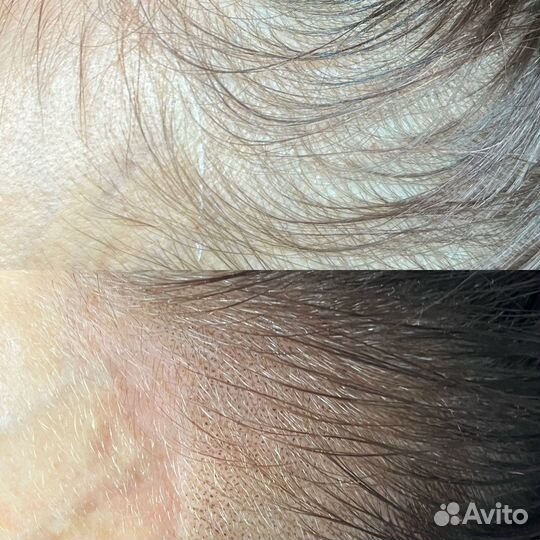 Трихопигментация головы по методу SMP