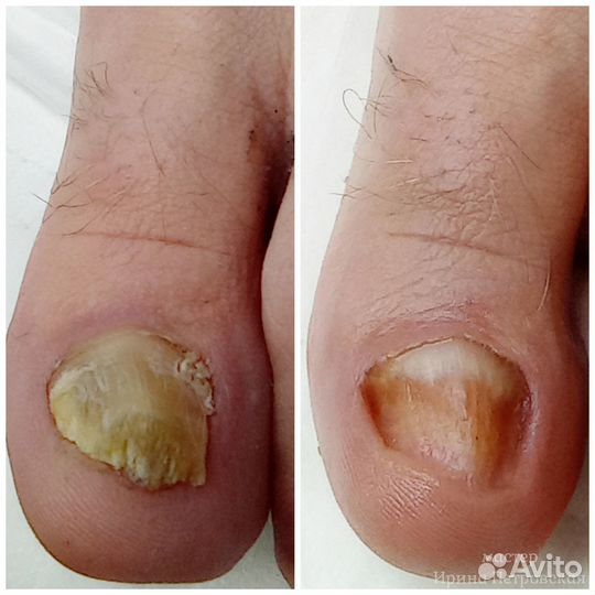 Педикюр. Подология