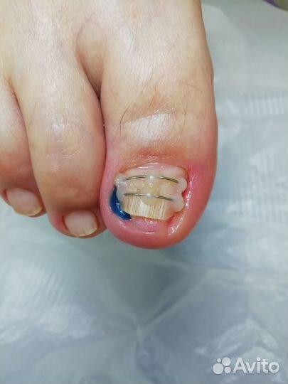 Педикюр аппаратный.парамедицинский