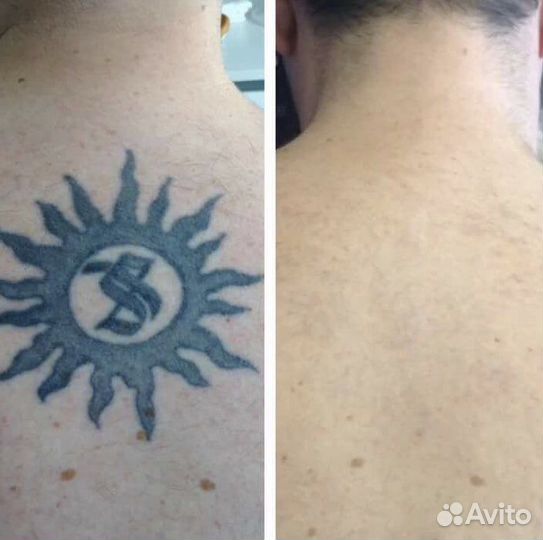 Удаление тату лазером