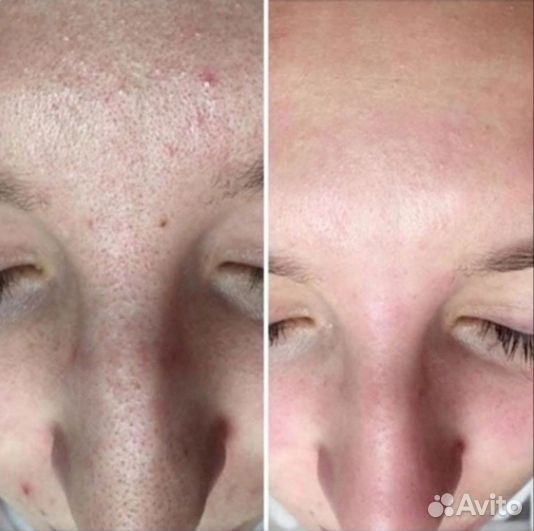 УЗ чистка лица, фонофорез, LED терапия