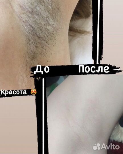 Шугаринг
