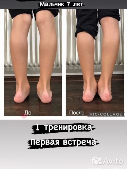 Коррекция вальгуса и осанки детям и взрослым