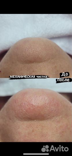 Чистка лица