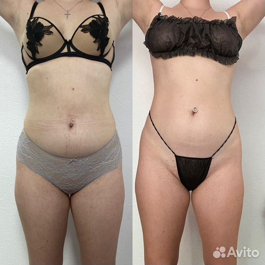 Ручной массаж, антицеллюлитный массаж