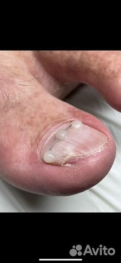 Установка коррекционной ситемы титановая нить