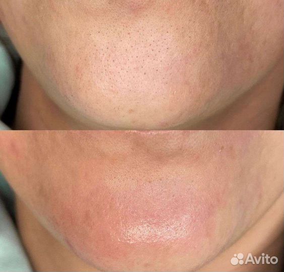 Косметолог чистка лица уз + механическая + пилинг