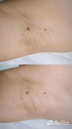 Шугаринг. Сахарная депиляция. Воск