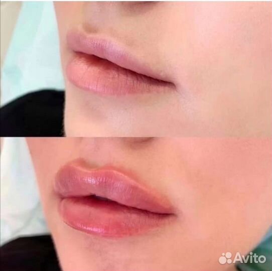 Увеличение губ