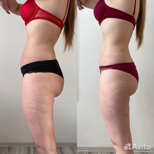 Антицеллюлитный LPG массаж, коррекция фигуры