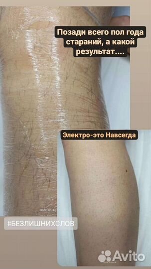 Электроэпиляция